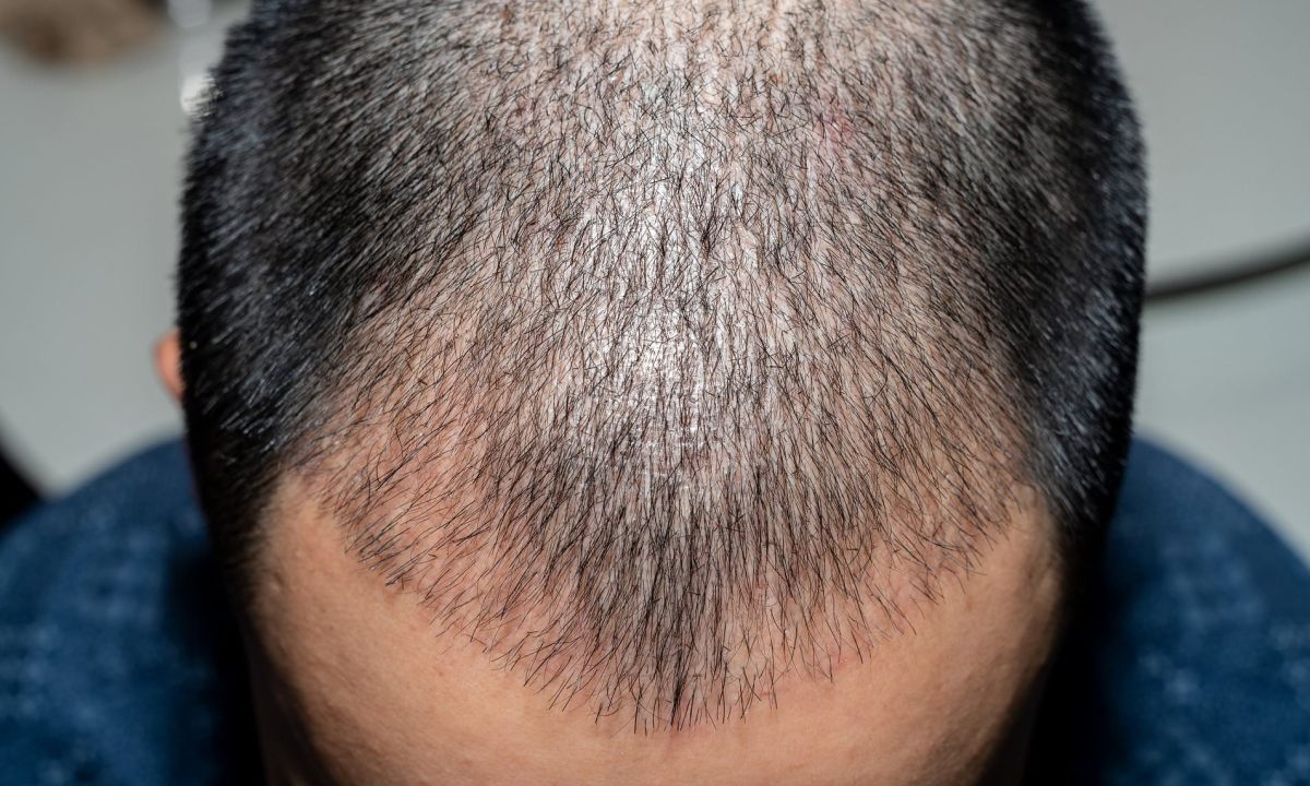 Is Thin Hair Transplantation Performed?
